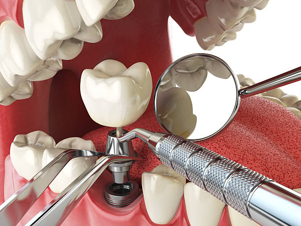 Best Emergency Tooth Extraction in Sawmills, NC